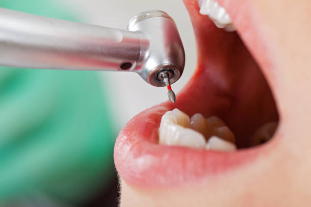 Best Emergency Root Canal Therapy in Fayette, MS